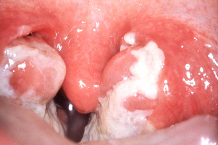 angine-diphtc3a9rique.jpg